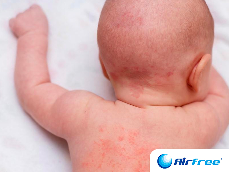 Alergias en bebés qué son, síntomas, y causas de riesgo