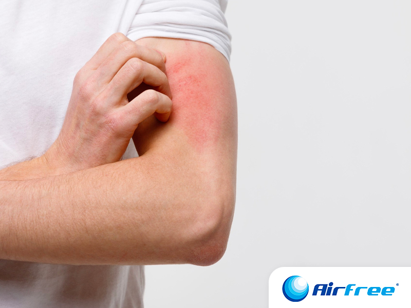 Alergia en la piel en verano: ¿cómo prevenirla y tratarla?
