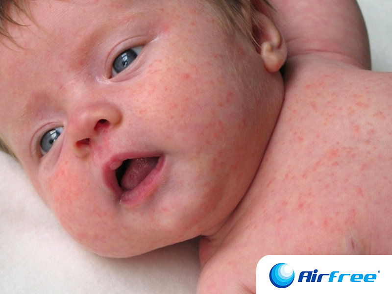 Cómo prevenir alergias en bebés